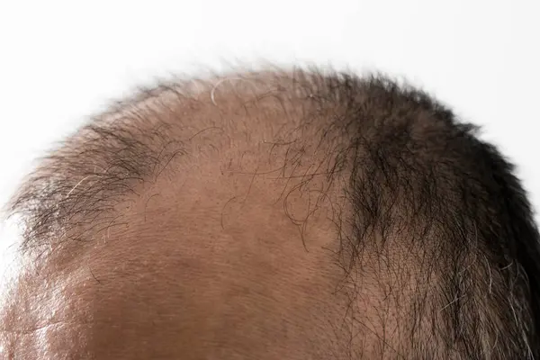 男人放松头发的主题 男人的头有一头秀发和秃顶的斑点 电影制片厂拍摄的白色背景 — 图库照片