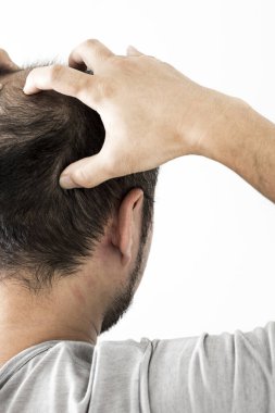 Adam saç temasını kaybediyor. Saç ve kellik lekesi olan bir erkek kafası. Beyaz arkaplanda stüdyo görüntüsü 