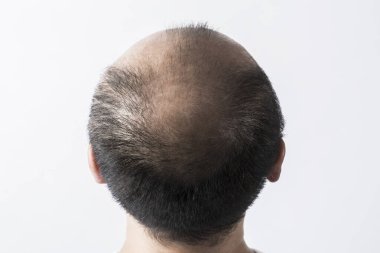 Adam saç temasını kaybediyor. Kafasında saç ve kellik lekesi var. Beyaz arkaplanda stüdyo görüntüsü 