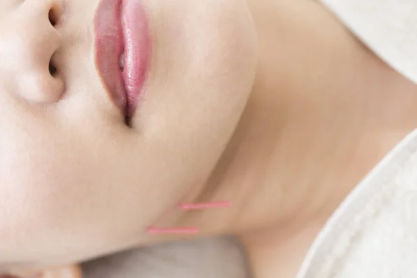 Wanita Jepang Cantik Mendapatkan Perawatan Akupunktur Spa Kecantikan — Stok Foto