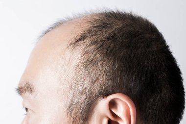 Adam saç temasını kaybediyor. Kafasında saç ve kellik lekesi var. Beyaz arkaplanda stüdyo görüntüsü 