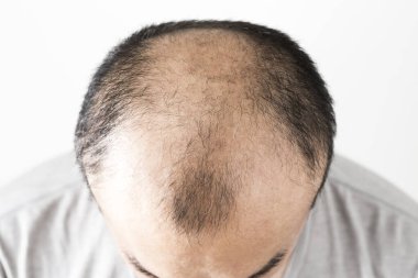 Adam saç temasını kaybediyor. Saç ve kellik lekesi olan bir erkek kafası. Beyaz arkaplanda stüdyo görüntüsü 