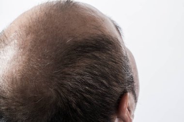 Adam saç temasını kaybediyor. Kafasında saç ve kellik lekesi var. Beyaz arkaplanda stüdyo görüntüsü 