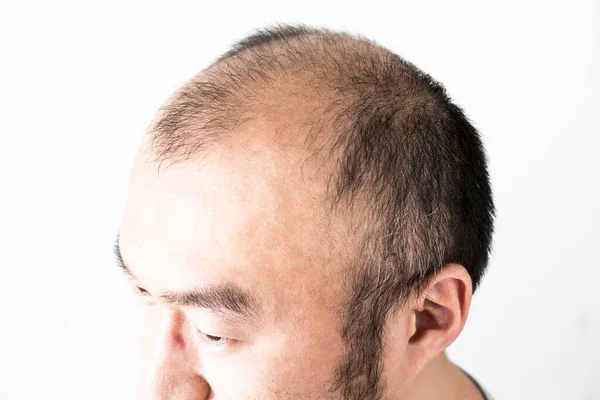 髪の毛のテーマを失った男 ソートヘアと脱毛スポットを持つ男性の頭部 ホワイトバックで撮影したスタジオ — ストック写真