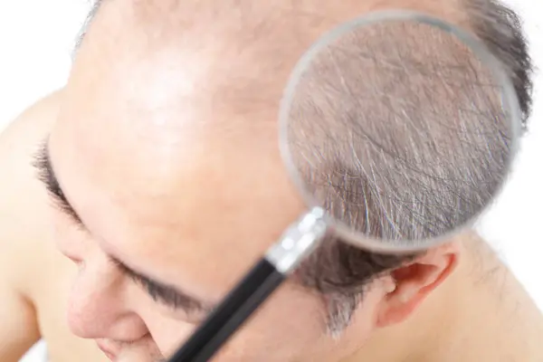 Man Hair Loss Problem Closeup — Stock Photo, Image