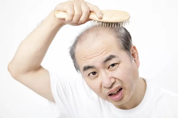 stock image Man loosing hair theme. Head with sort hair and baldness spot. Studio shot on white background 