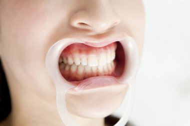 dişlerini diş kliniğinde gösterilen kadın