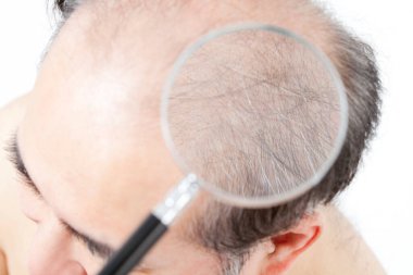 Beyaz arka planda kayıp sorunu olan bir adam, yakın plan. sorun kaybı sorunları