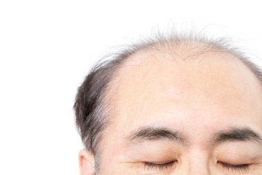 Saç dökülme sorunu olan son sınıf öğrencisi. 