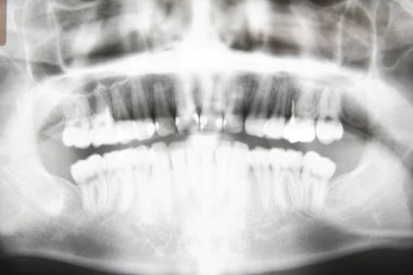 Diş röntgeni. Çenenin dişleri