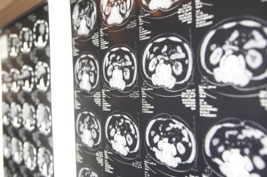 Arka planda beyin ve manyetik beyin rezonansı MRI taraması, kapatın.