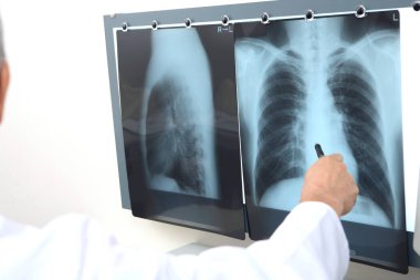Ciğerleri röntgen ışınlı doktor.