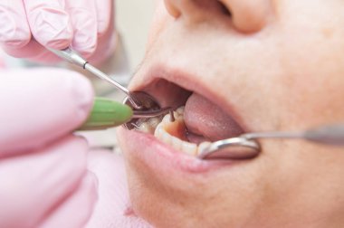 Takma dişler. Dişlerin yakın fotoğrafını çek. Bir hastayı muayene eden dişçi.