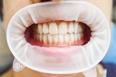 Takma dişler. Dişlerin yakın fotoğrafını çek. Bir hastayı yakından inceleyen dişçi. Çıkarılabilir takma diş. Güzel Hollywood Gülümsemesi. 