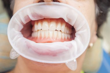 Takma dişler. Dişlerin yakın fotoğrafını çek. Bir hastayı yakından inceleyen dişçi. Çıkarılabilir takma diş. Güzel Hollywood Gülümsemesi. 