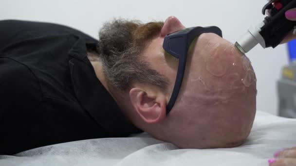 Zbliżenie Brodatego Odważnego Człowieka Depilacja Laserowa Depilacja Włosów Zabieg Niebolesny — Wideo stockowe