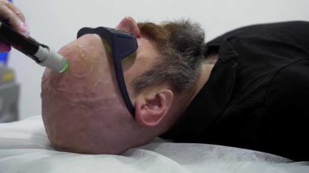 Close Bearded Bold Man Protective Glasses Head Depilation Laser Hair — Stockvideo