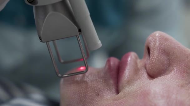 波蒂西亚美容师用激光技术进行分步微囊间质治疗的特写镜头 客户美容院五金美容术 — 图库视频影像