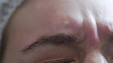 Beautician doctor makes botox injection in the forehead of young beauutiful wpman. Extreme close up 4k shot. Beauty technology concept