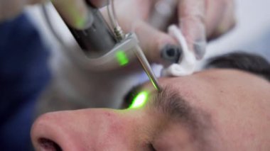 Close up man face epilation laser hair removal procedure treatment, unpainful procedure, beauty concept, alexandrite laser