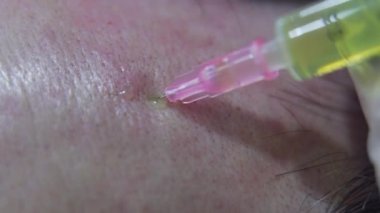 Close up shot of plasma treatment, plasmolifting or PRP method point the introduction of the patients own plasma enriched with platelets, in the problem areas of the skin. High quality 4k footage