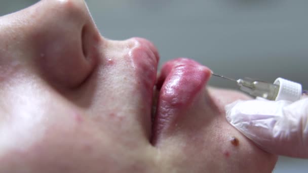 Médico Esteticista Hace Inyección Botox Los Labios Joven Hermoso Wpman — Vídeo de stock