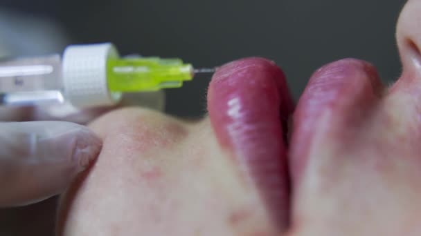 Beautician Arts Maakt Botox Injectie Lippen Van Jonge Schoonheidsspecialiste Extreme — Stockvideo