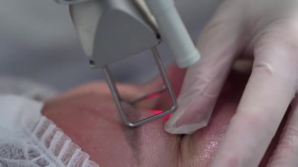 Extreme Close Shot Beautician Cosmetologist Doing Procedure Fractional Microneedle Mesotherapy — Stok video