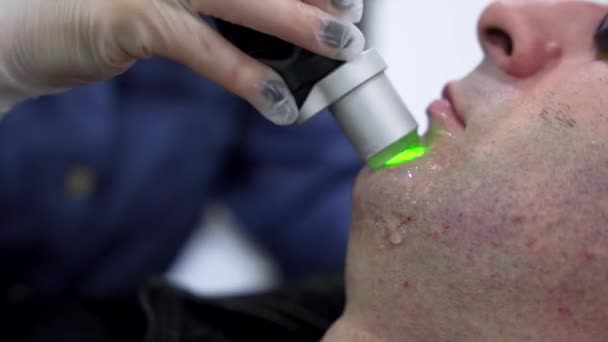 Лазерная Эпиляция Лица Человека Лечение Лазерной Эпиляции Неболезненная Процедура Концепция — стоковое видео