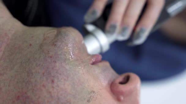 閉じる男の顔の脱毛レーザー脱毛手順治療 痛みのない手順 美しさの概念 アレキサンドライトレーザー — ストック動画
