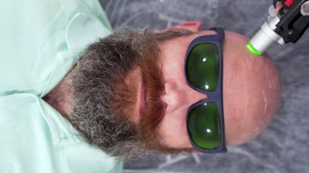 Close Bearded Bold Man Head Epilation Laser Hair Removal Procedure — Stock videók