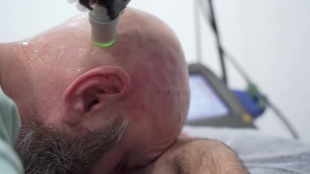 Κοντινό Πλάνο Γενειοφόρος Τολμηρός Άνθρωπος Κεφάλι Αποτρίχωση Λέιζερ Θεραπεία Διαδικασία — Αρχείο Βίντεο