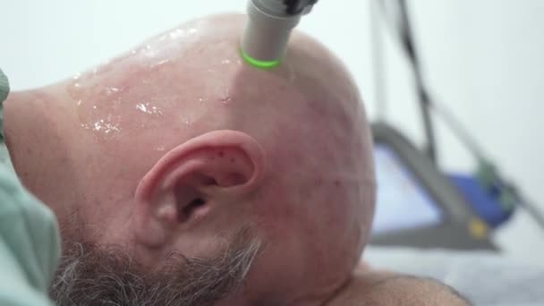 Κοντινό Πλάνο Γενειοφόρος Τολμηρός Άνθρωπος Κεφάλι Αποτρίχωση Λέιζερ Θεραπεία Διαδικασία — Αρχείο Βίντεο