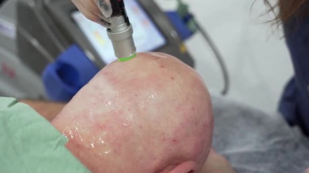 Close Baardvet Man Hoofd Ontharing Laser Ontharing Procedure Behandeling Onpijnlijke — Stockvideo