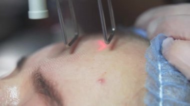 Extreme close up shot of Beautician cosmetologist doing procedure fractional microneedle mesotherapy rejuvenation with laser technology. Hardware cosmetology in clinic salon for client.