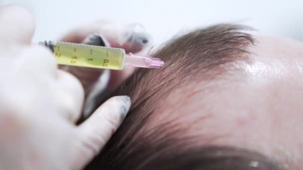 現代の美容クリニックでのヘアメソセラピー手順のマクロショット 血漿注射 中年男性の患者の髪の成長のための準備手順 美の概念 — ストック動画