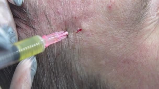 Macro Shot Van Hair Mesotherapy Procedure Moderne Kosmetologie Kliniek Plasma — Stockvideo