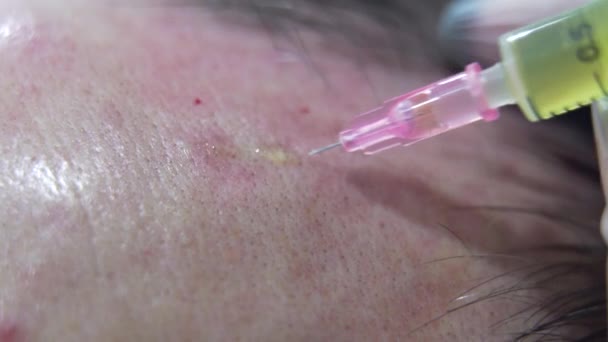 Makro Shot Zabiegu Mezoterapii Włosów Nowoczesnej Klinice Kosmetologii Zastrzyki Osocza — Wideo stockowe
