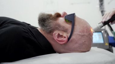Close up bearded bold man in protective glasses head depilation laser hair removal procedure treatment, unpainful procedure, beauty concept, alexandrite laser