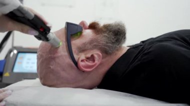 Close up bearded bold man in protective glasses head depilation laser hair removal procedure treatment, unpainful procedure, beauty concept, alexandrite laser