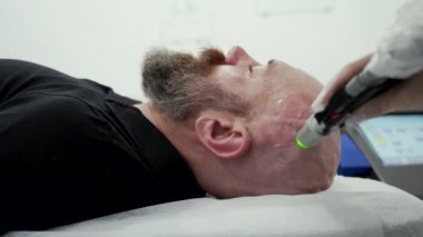 Close up bearded bold man in protective glasses head depilation laser hair removal procedure treatment, unpainful procedure, beauty concept, alexandrite laser