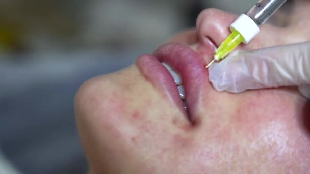 美容师医生在年轻漂亮女人的唇上注射肉毒杆菌素 非常接近4000发子弹 美感科技概念 — 图库视频影像
