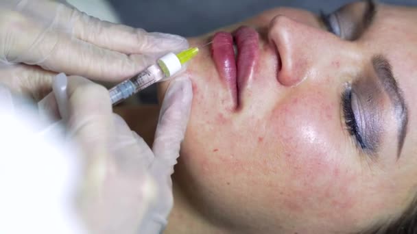 Beautician Läkare Gör Botox Injektion Läpparna Unga Vackra Kvinna Färgkorrigerad — Stockvideo