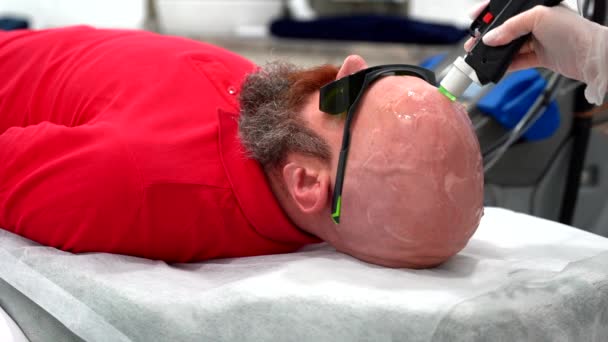 Bold Man Head Epilation Laser Hair Removal Procedure Treatment Alexandrite — Αρχείο Βίντεο