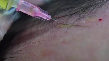 Modern kozmetik kliniğinde saç terapisinin makro aşısı, plazma enjeksiyonları. Orta yaşlı erkek hasta prp prosedürü. Saç uzatmak için. Güzellik konsepti.