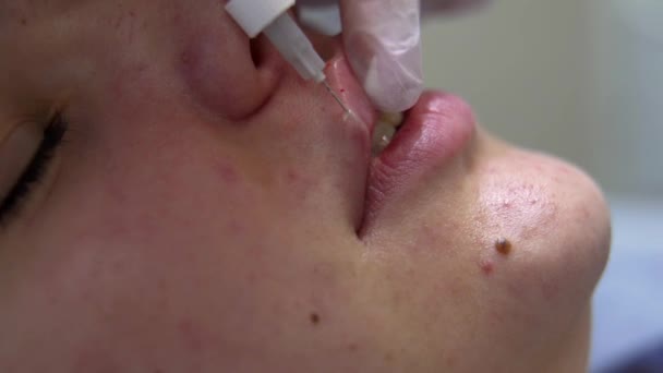 Medicul Veterinar Face Injecția Botox Buzele Tinerei Femei Frumoase Extrem — Videoclip de stoc