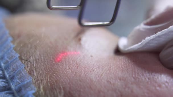 Extreme Close Shot Beautician Cosmetologist Doing Procedure Fractional Microneedle Mesotherapy — Stock videók