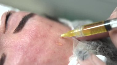 Modern kozmetoloji kliniğinde makro mesoterapi aşısı, plazma enjeksiyonları. Orta yaşlı kadın hasta prp prosedürü. Güzellik konsepti.