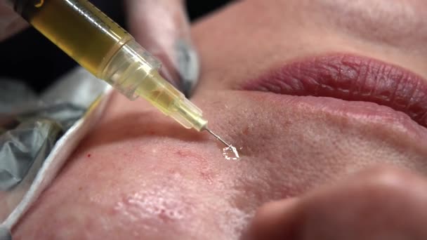 Kozmetik Uzmanı Kadın Vücuduna Birden Fazla Enjeksiyon Yapıyor Cilt Elmacık — Stok video