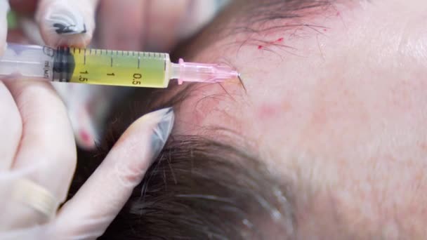 현대적 클리닉인 주입제 Plasma Injectiion 머리카락 절차에 매크로 중년의 환자로 — 비디오